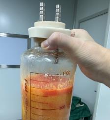 北海水动力吸脂手术要做多久？